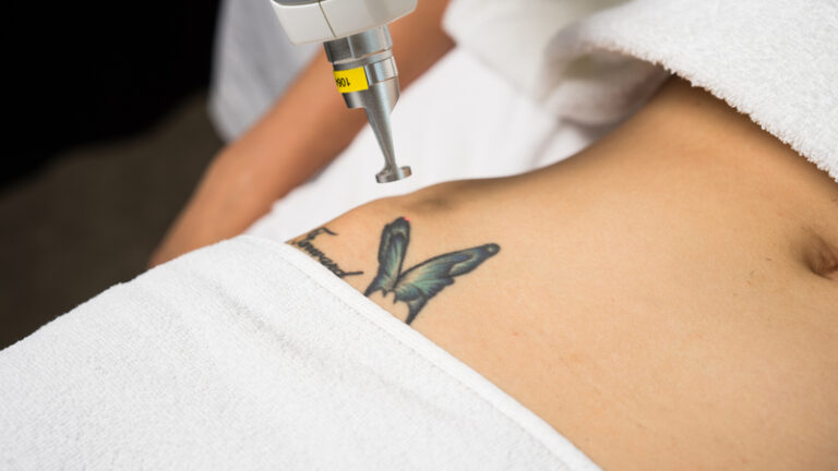Jak bezpiecznie usunąć tatuaż?